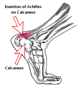 Severs Disease