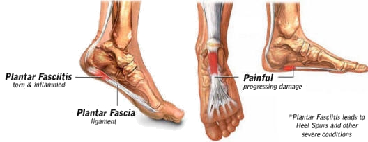 Plantar Fasciitis treatment